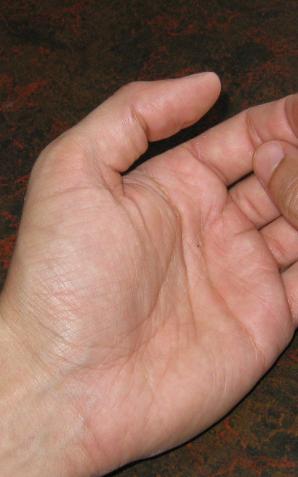 Tylko 15 proc. osób ze schizofrenią jest aktywnych zawodowo. Mimo że odpowiednio leczeni pacjenci mogą prowadzić normalne życie